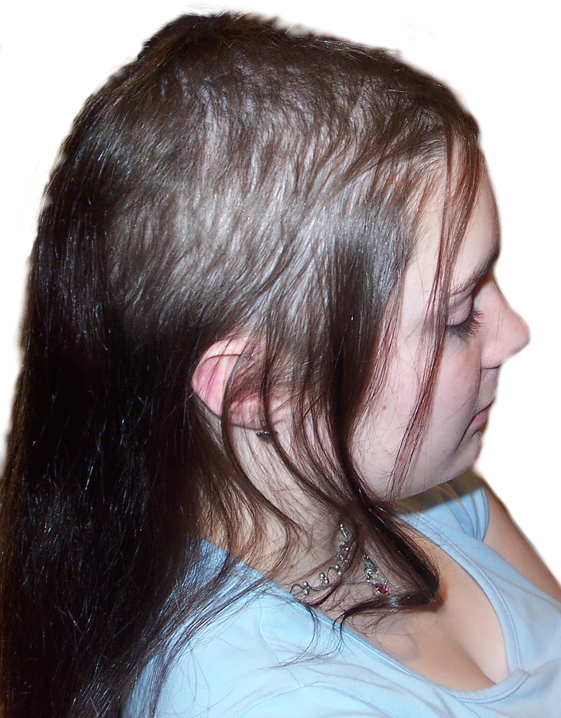 Before Picture - Trichotillomania & Full Recovery